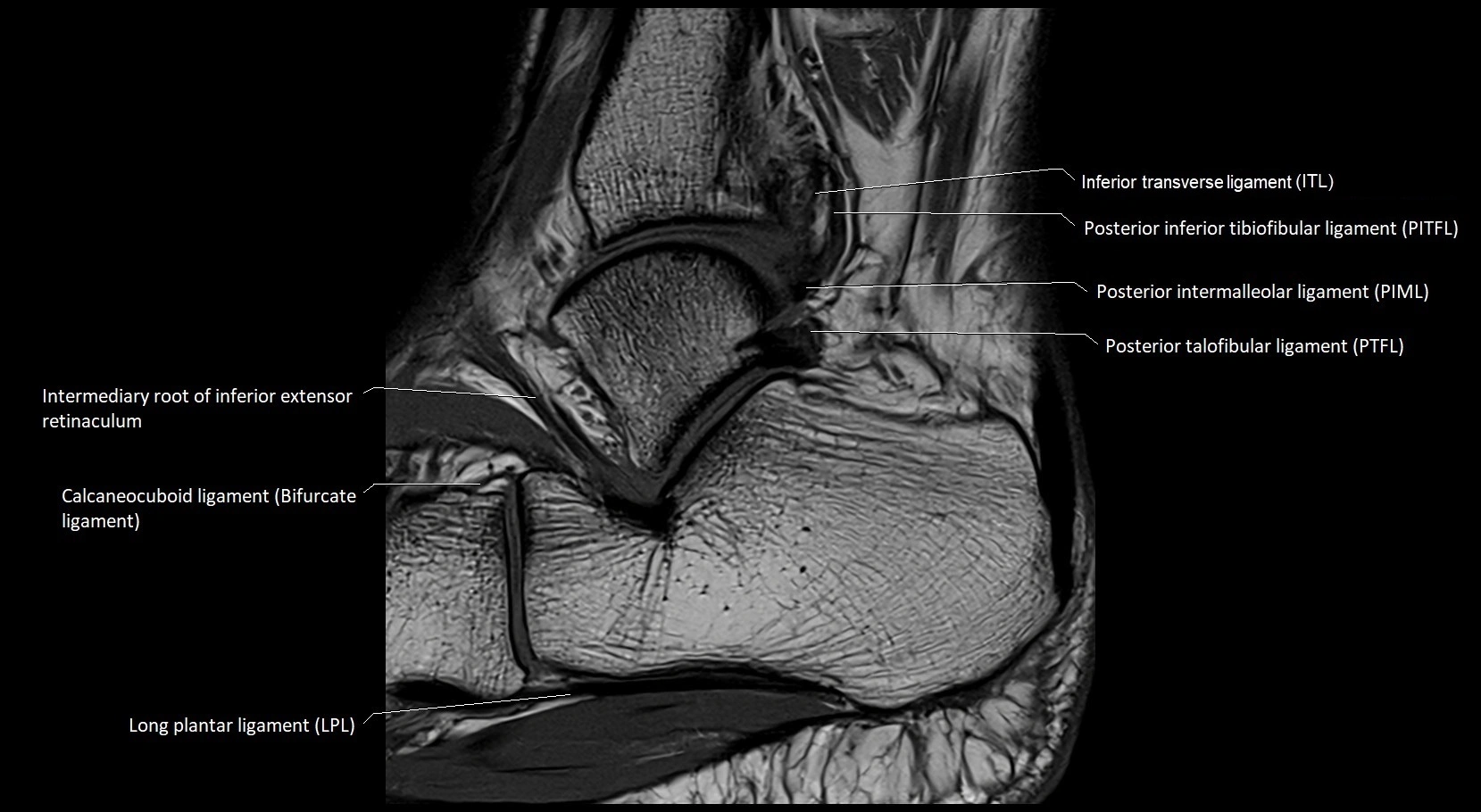 MRI ankle ligaments anatomy sagittal 3T image 20.webp
